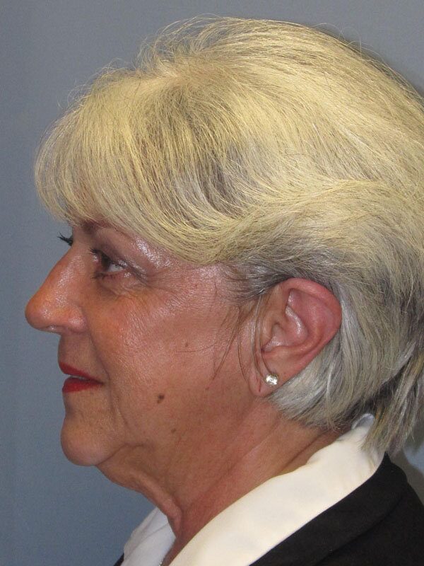 Before — Lite Lift, Liposuction of the neck, Brow Lift, Blue Peel