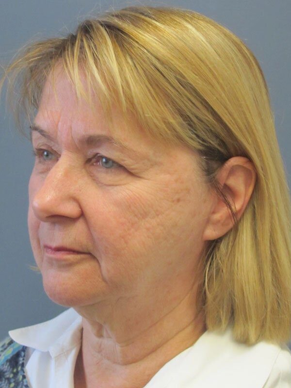 Before — Lite Lift, upper and lower eyelid lift, liposuction of the neck, blue peel