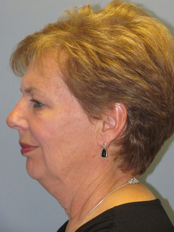 Before — Lite Lift™, liposuction of the neck, lower eyelid lift