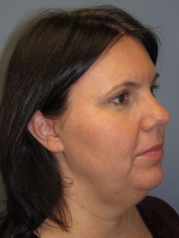 Before — Lite Lift™, liposuction of the neck