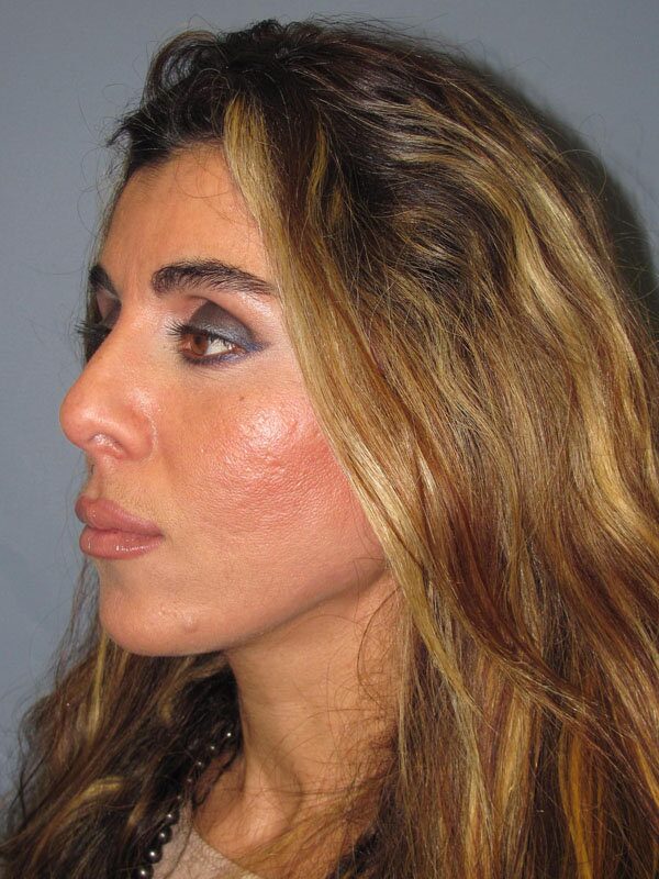 After — Lite Lift™