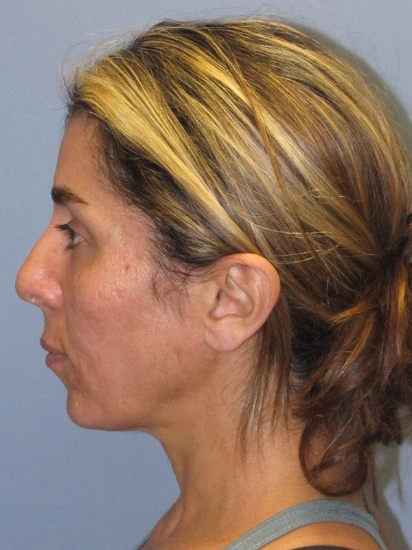 Before — Lite Lift™