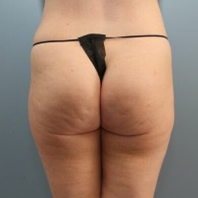 Before — Female patient treated with Cellfina for cellulite removal