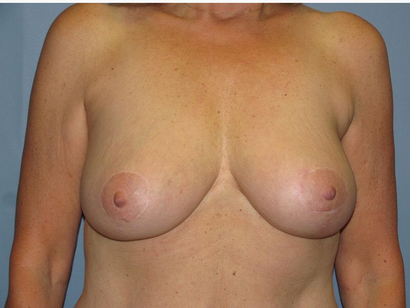 After — Breast Reduction, Breast Lift