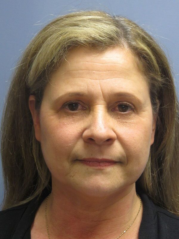 Before — Fat Transfer, Lite Lift, Mini Facelift, Brow Lift