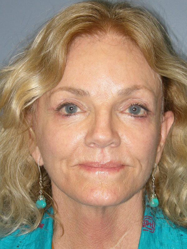 After — Fat Transfer, Lite Lift, Mni Facelift, Eyelid Lift