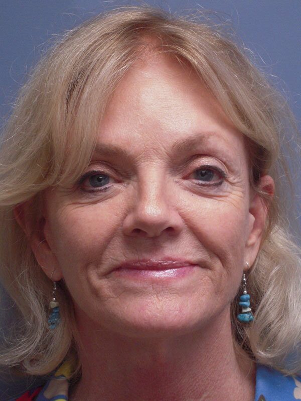 Before — Fat Transfer, Lite Lift, Mni Facelift, Eyelid Lift