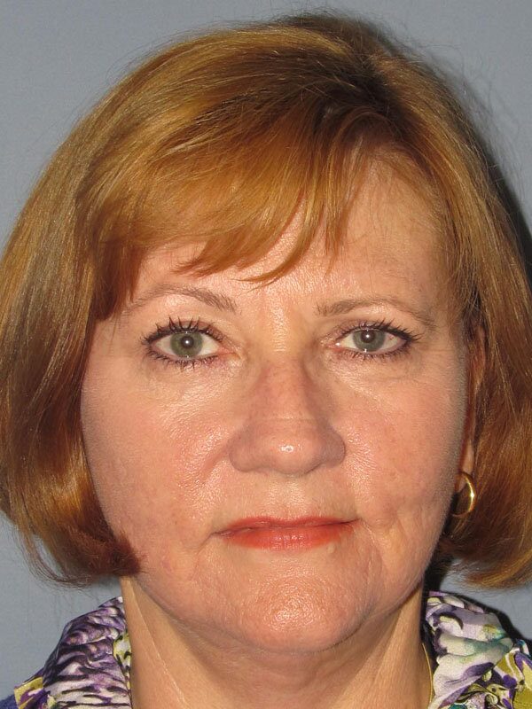 Before — Fat Transfer, Lite Lift, Mini Facelift, Neck Lift, Blue Peel