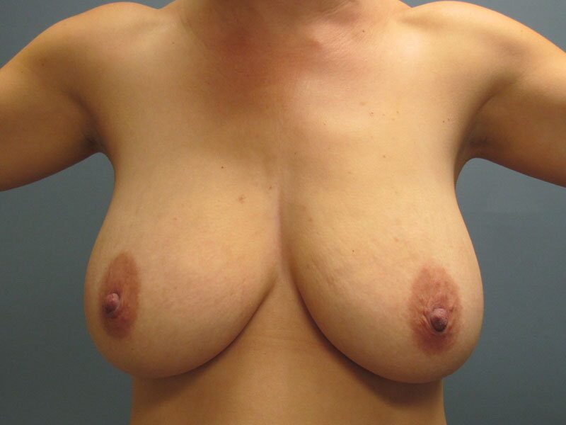 Before — Breast Reduction, Fat Transfer