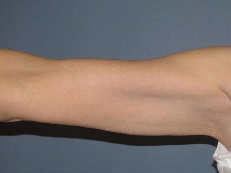 After — Fat Transfer