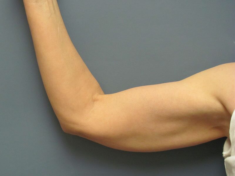Before — Fat Transfer