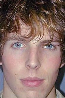 After — Nose Surgery, Rhinoplasty