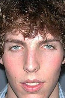 Before — Nose Surgery, Rhinoplasty