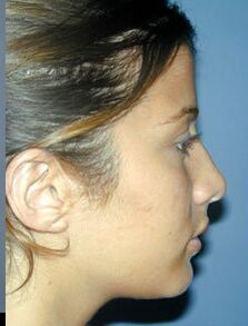 After — Nose Surgery, Rhinoplasty