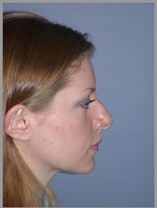 Before — Nose Surgery, Rhinoplasty