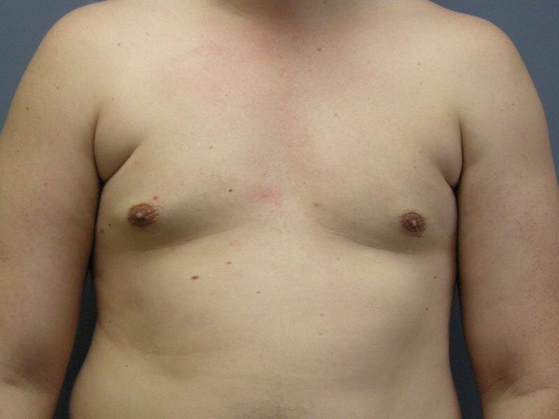 After — male breast reduction, gynecomastia