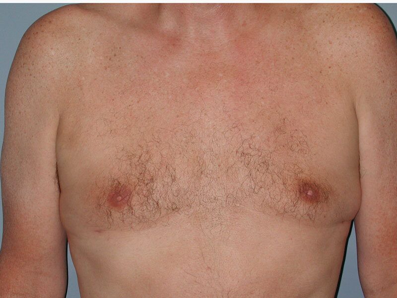 After — Gynecomastia, Male Breast Reduction
