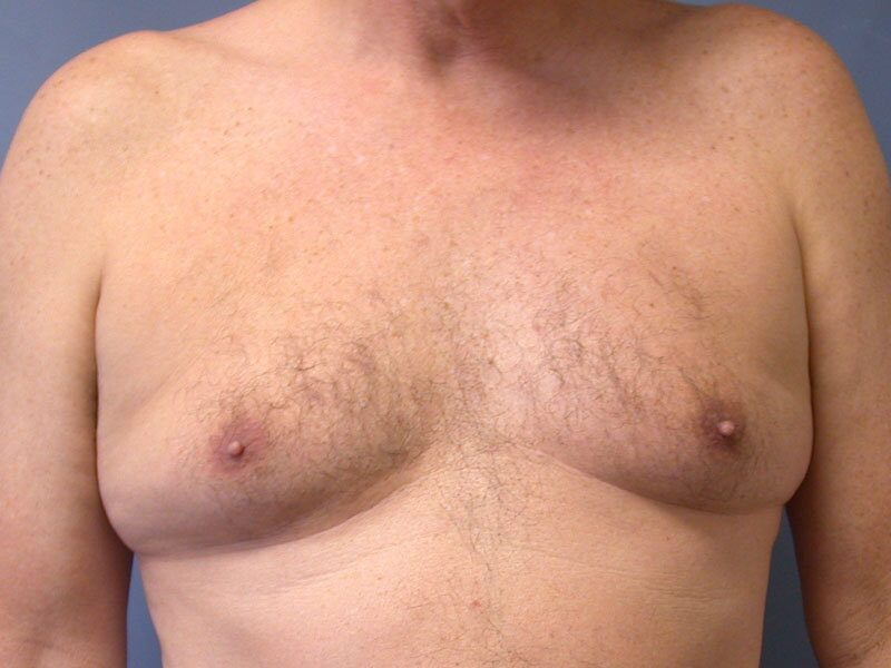 Before — Gynecomastia, Male Breast Reduction