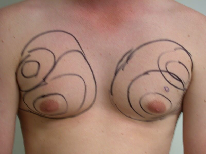 Before — Gynecomastia, Male Breast Reduction