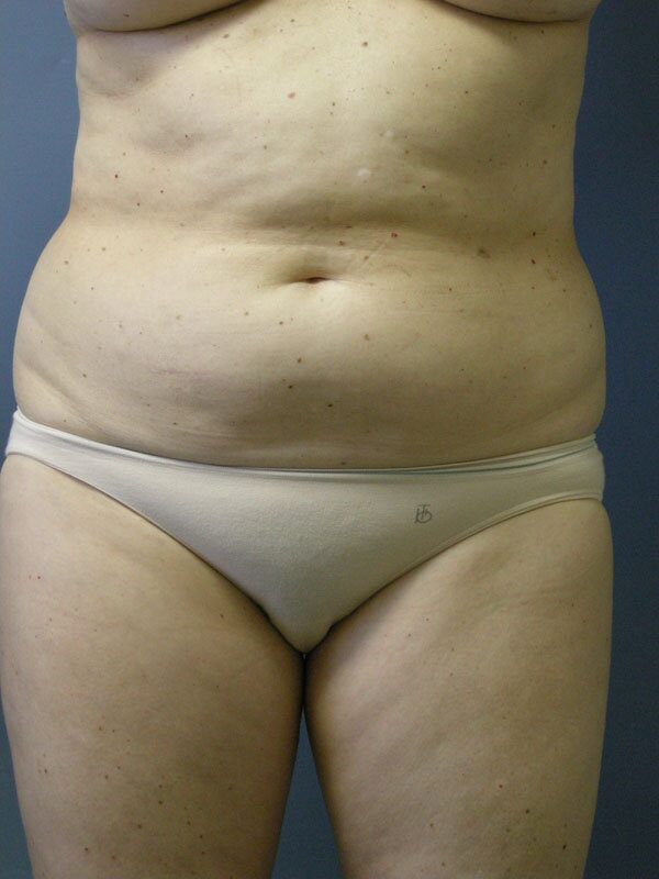 Before — Liposuction of Abdomen