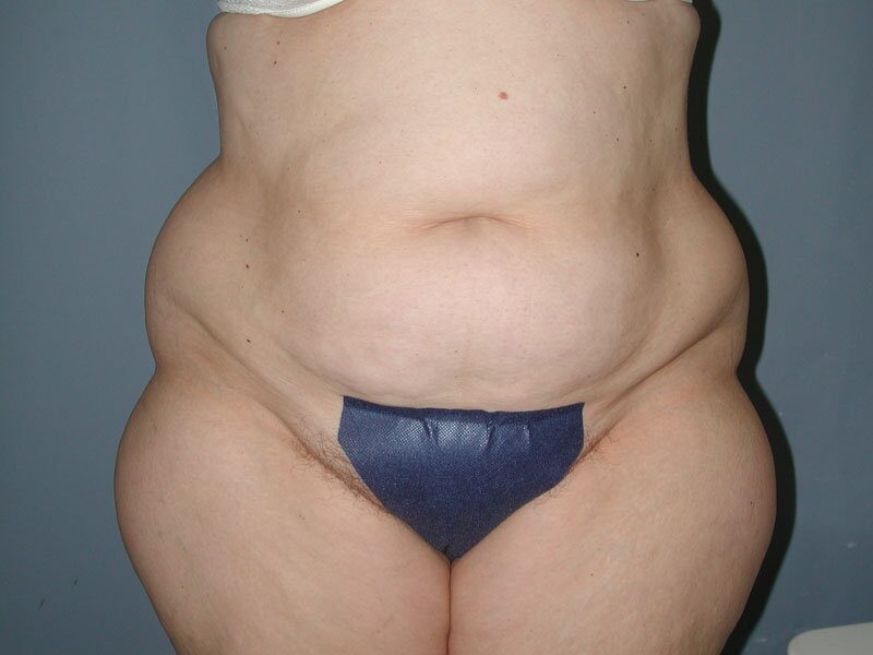 Before — Liposuction hips, waist, upper and lower abdomen, lateral thighs
