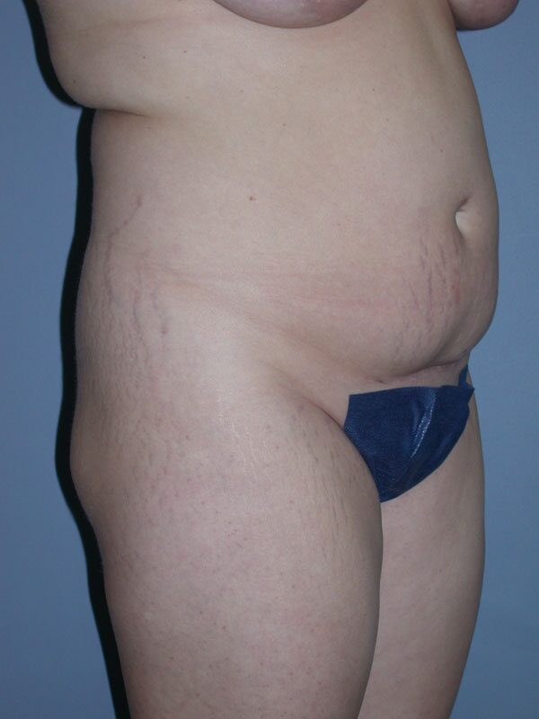 Before — Liposuction