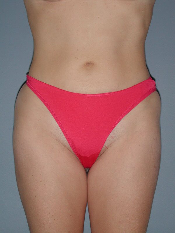 After — Liposuction