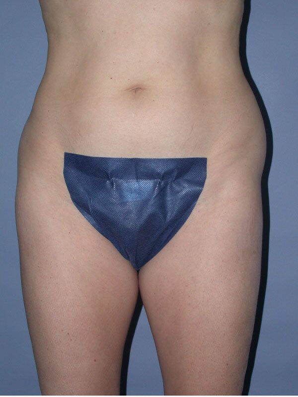 Before — Liposuction
