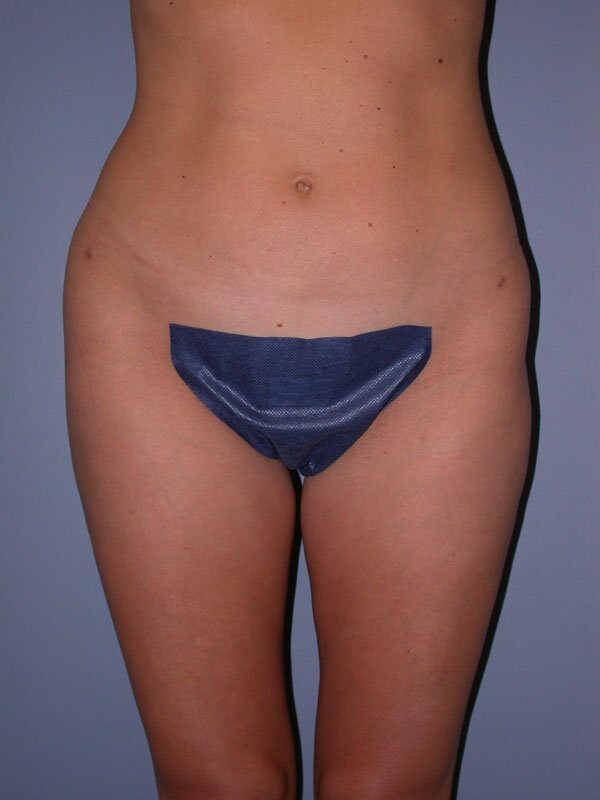 After — Liposuction