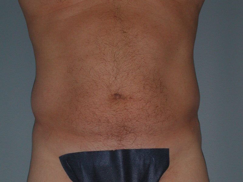 After — Liposuction