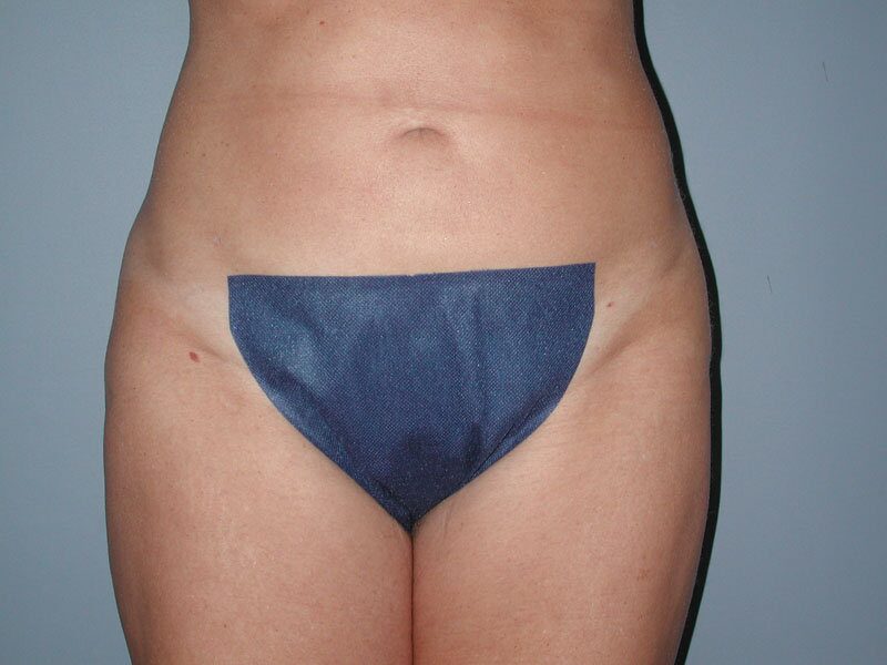 After — Liposuction