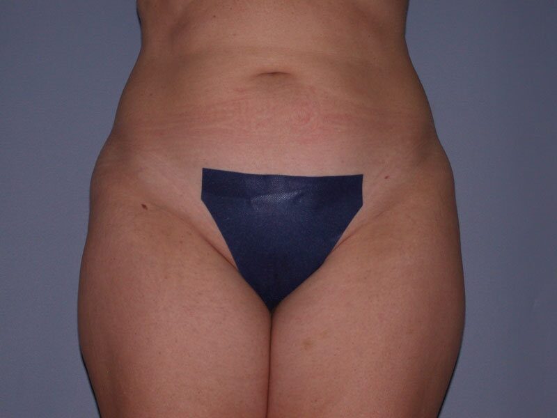 Before — Liposuction