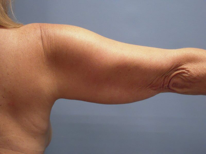 Before — Liposuction