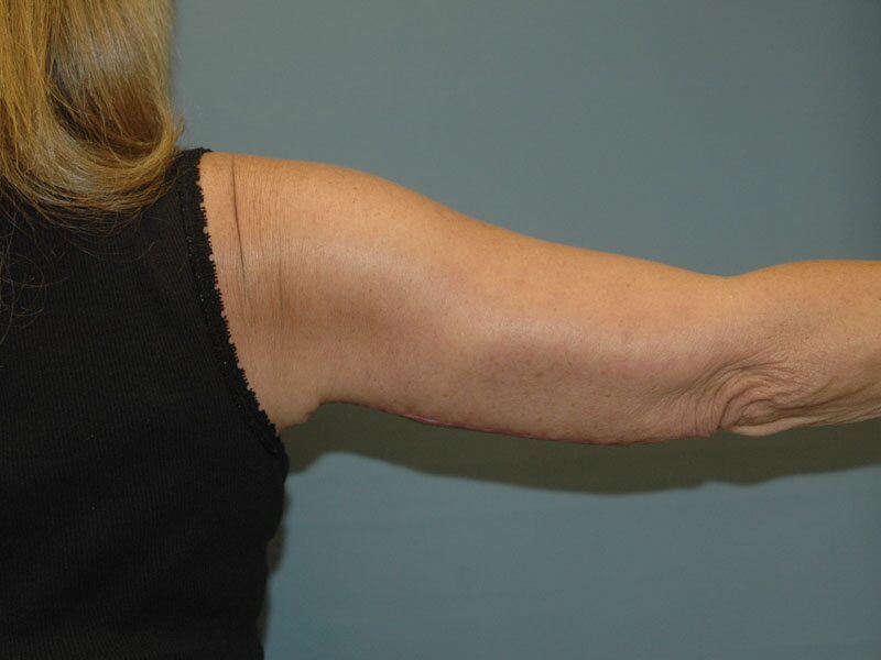 After — Arm lift, brachioplasty