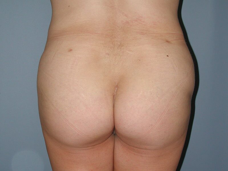 After — Brazilian Butt lift, fat transfer