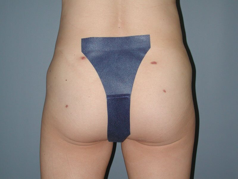 After — Brazilian Butt Lift, Fat Transfer