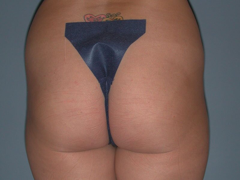 Before — Brazilian Butt Lift, Fat Transfer