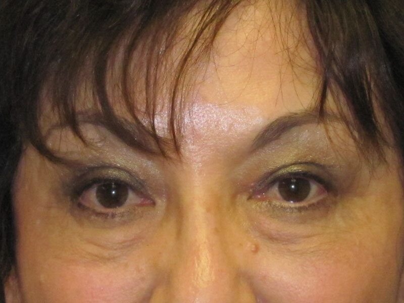 After — Fat Transfer