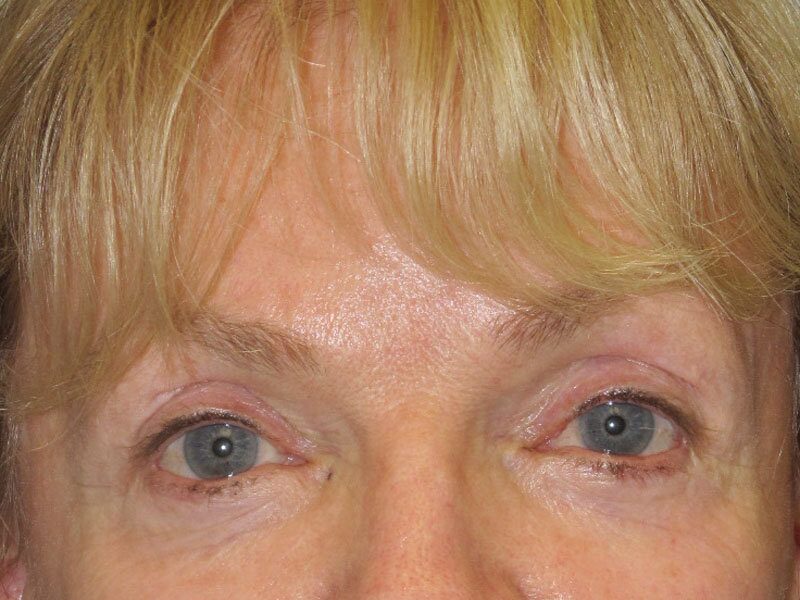After — Fat Transfer