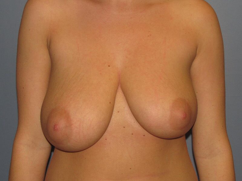 Before — Breast Reduction, Mastopexy, Breast Lift, Correction of Breast Asymmetry