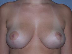 After — Breast Reduction, Mastopexy, Breast Lift.