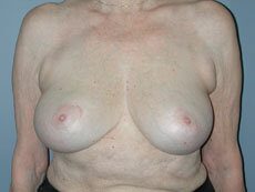 After — Breast Reduction, Breast Lift, Mastopexy