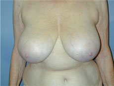 Before — Breast Lift, Mastopexy, Breast Reduction