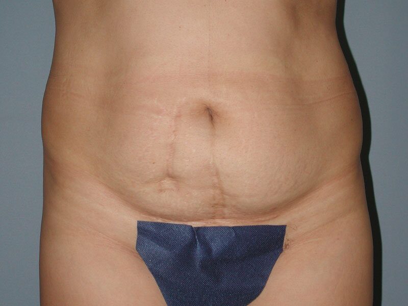 Before — Tummy Tuck, Abdominoplasty