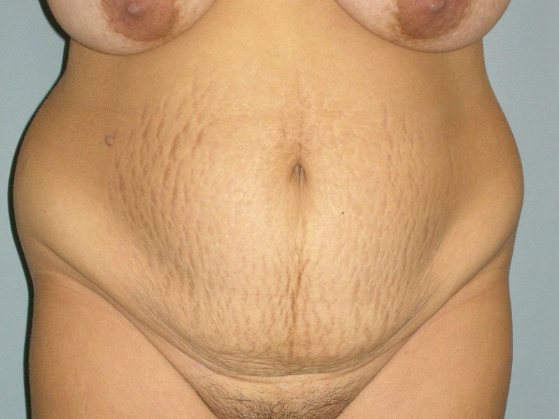 Before — Tummy Tuck, Abdominoplasty