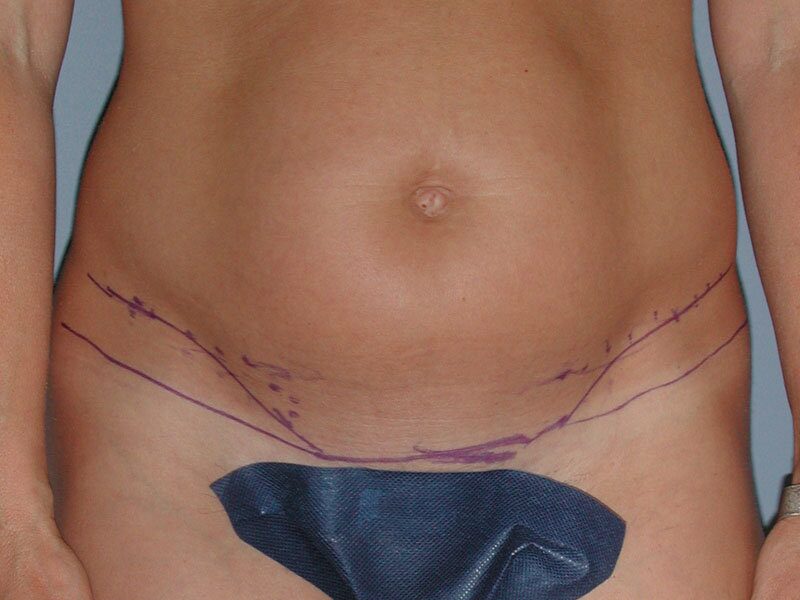 Before — Tummy Tuck, Abdominoplasty