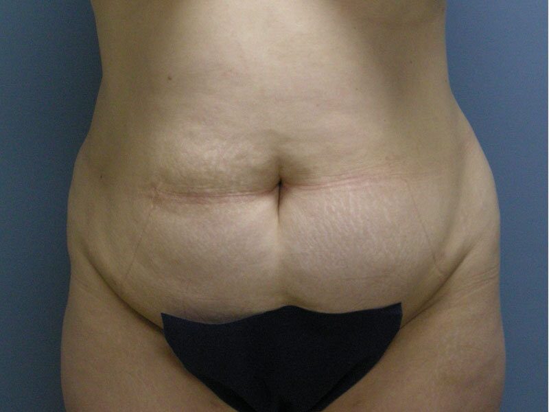 Before — Tummy Tuck, Abdominoplasty