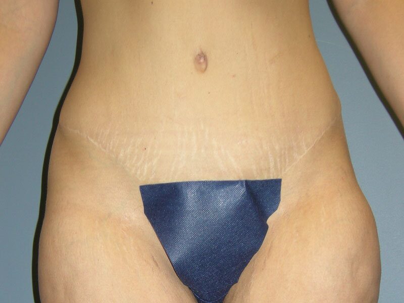 After — Tummy Tuck, Abdominoplasty