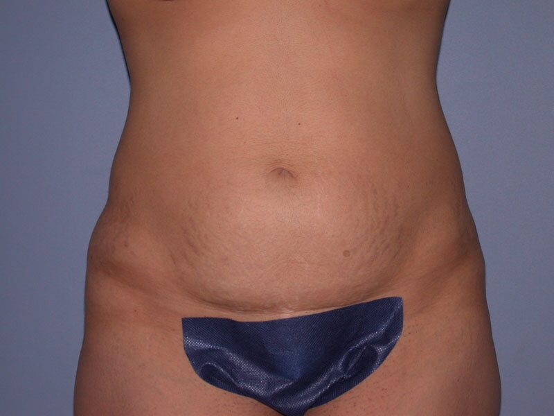 Before — Tummy Tuck, Abdominoplasty