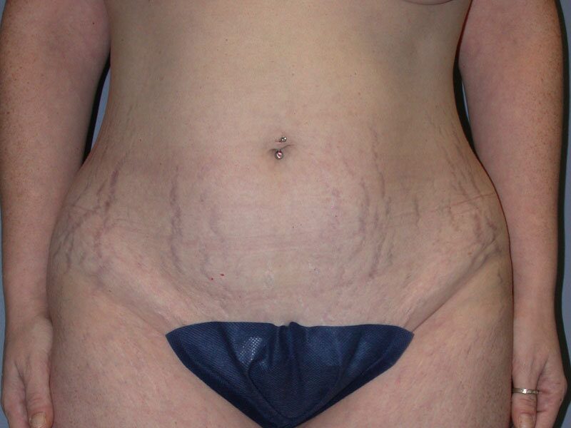Before — Tummy Tuck, Abdominoplasty